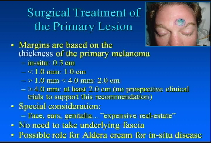 Thumbnail image for Melanoma: Diagnosis & Treatment - Dr. Wayne Stadelmann